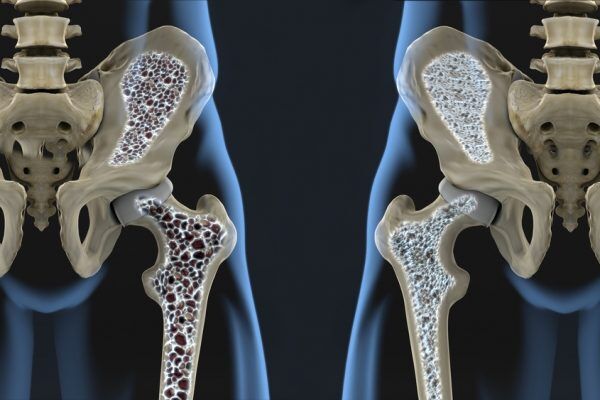 osteoporosis