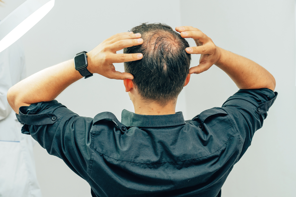 The link between testosterone and hair loss
