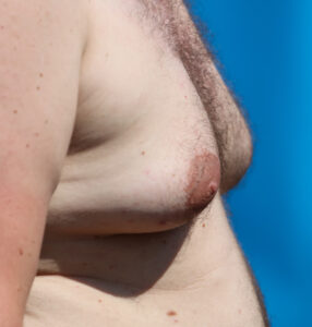 gynecomastia